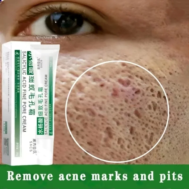 Salicylic Acid Blackhead Remover - Ácido salicílico poros limpeza creme encolher